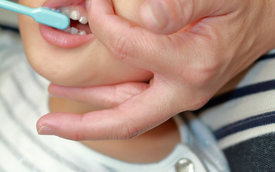 Tooth Decay in Children (Caries and Cavities)